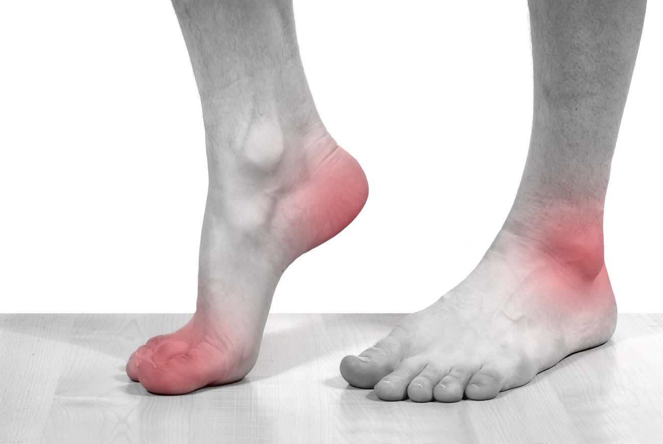 Chân bị sưng phù và đau nặng hơn ở giai đoạn sau 