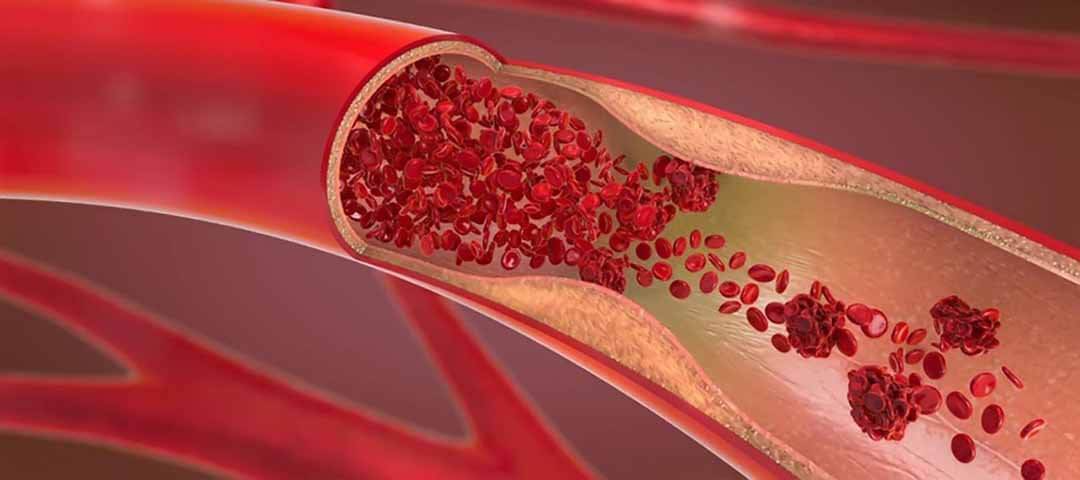 Tăng cường lưu thông máu nhờ thiết kế mô phỏng sinh học 
