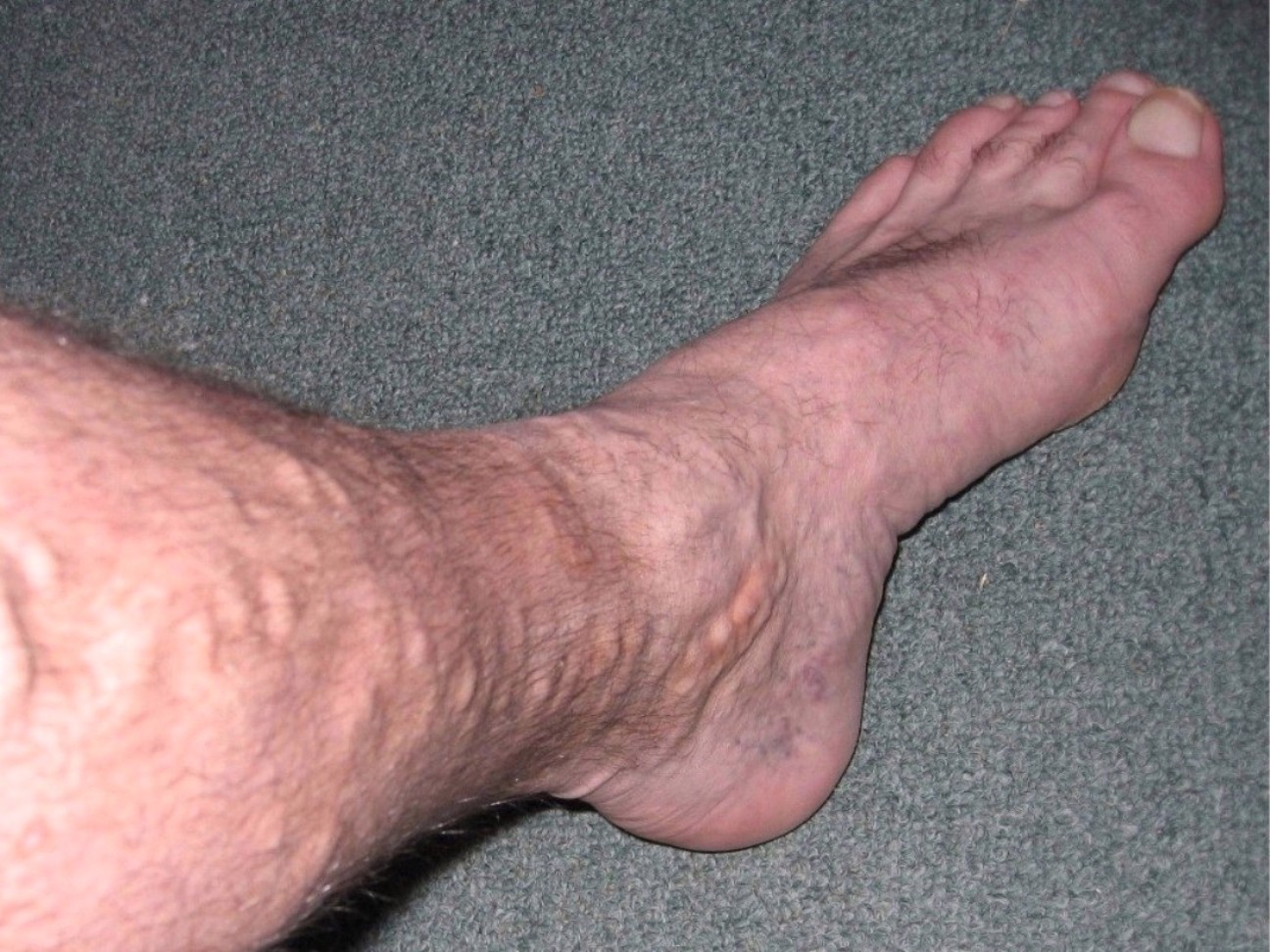 Tĩnh mạch chân nổi gồ hẳn lên da khi bệnh trở nặng