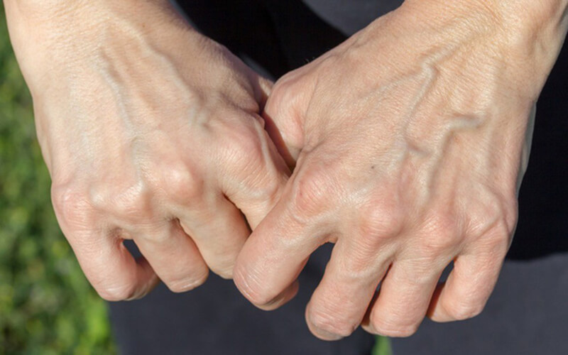 Tĩnh mạch tại bàn tay bị suy yếu giãn rộng, có kích thước lớn bất thường