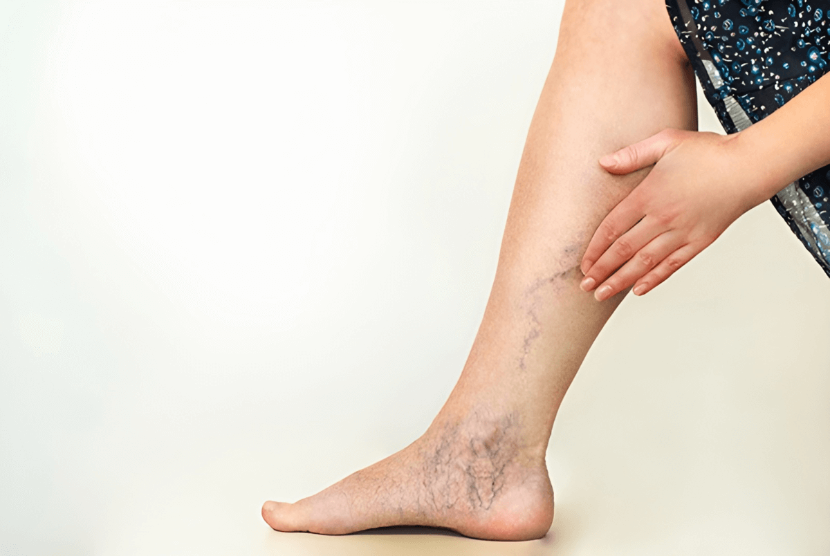 Giãn tĩnh mạch bàn chân là bệnh phổ biến ở người trưởng thành